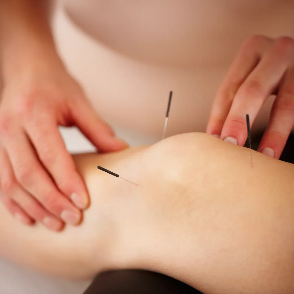 halton physiotherapy treatment accupuncture